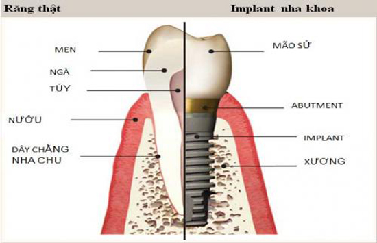Miễn phí cấy ghép xương và tặng răng sứ khi trồng răng Implant - 1