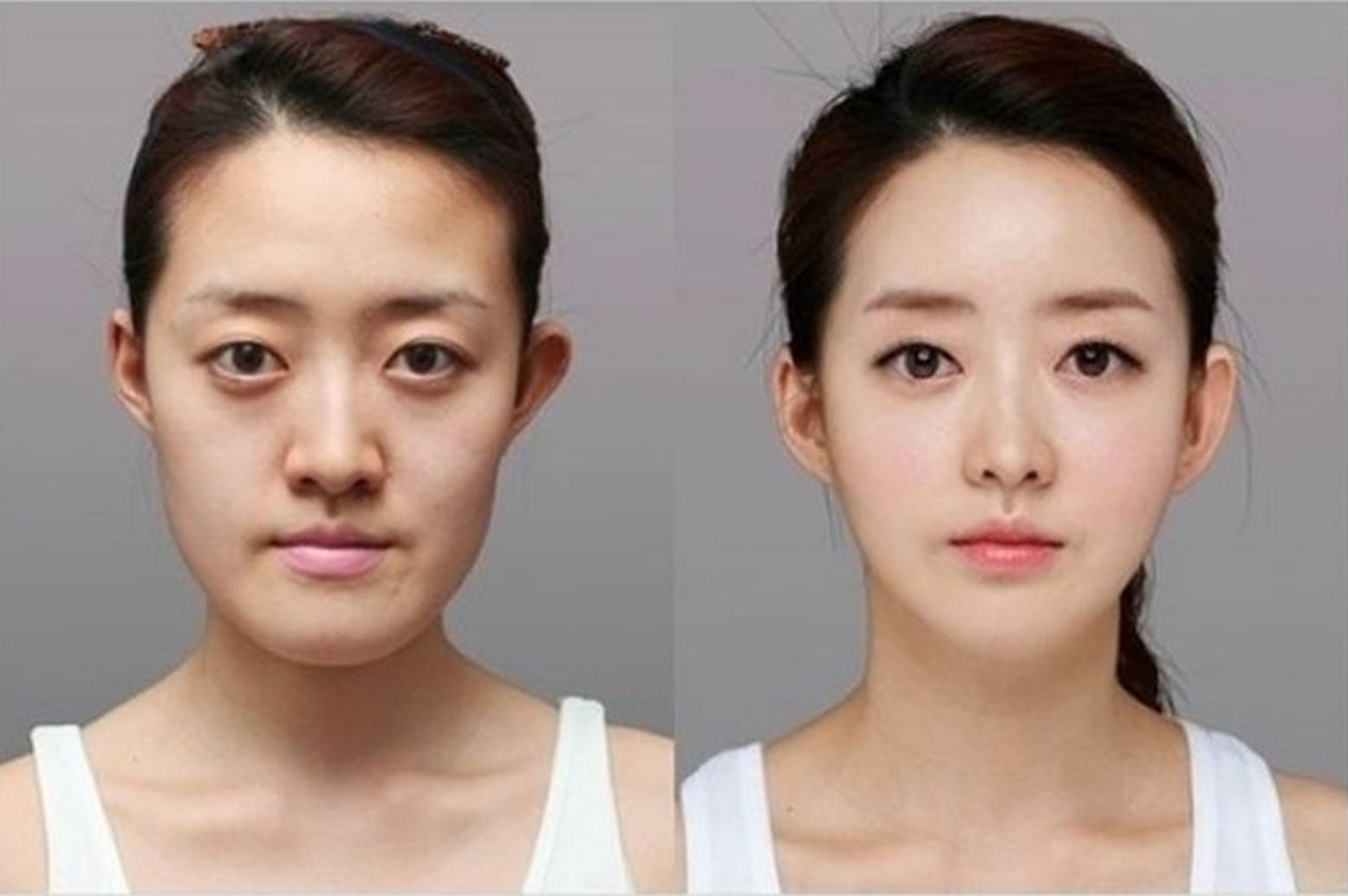 пластика лица женщин фото