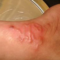 Sức khỏe đời sống - Suy kiệt, tử vong do giun đũa chó