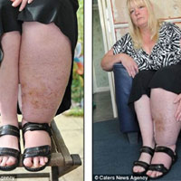 Phi thường - kỳ quặc - Sống với chân khổng lồ suốt 20 năm