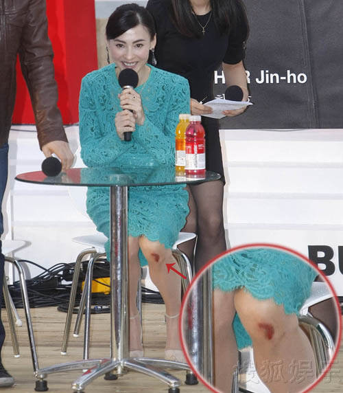 Trương Bá Chi lộ vết thương ở đầu gối - 2