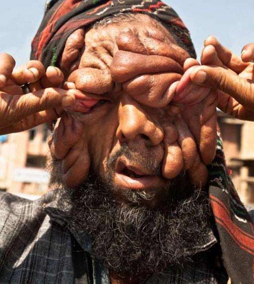 Xót xa người đàn ông "mặt quỷ" ở Ấn Độ - 2