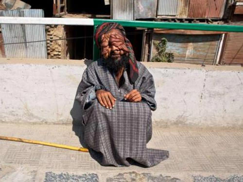 Xót xa người đàn ông "mặt quỷ" ở Ấn Độ - 3