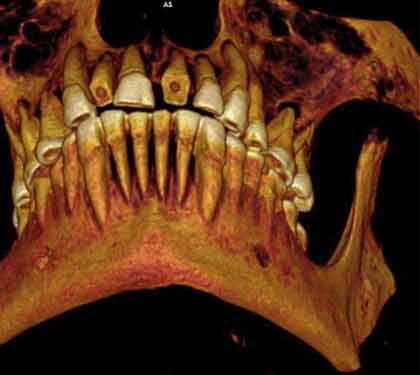 Tin tức trong ngày - Ai Cập: Xác ướp người chết vì sâu răng