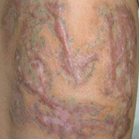 Sức khỏe đời sống - Biến dạng vì xăm và xóa xăm trên cơ thể