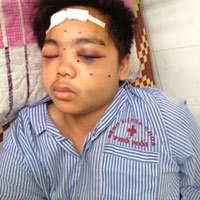 Pháp luật - Nam sinh bị 34 mảnh đạn găm vào mặt