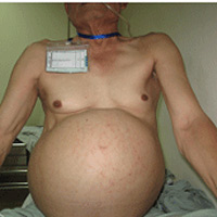 Sức khỏe đời sống - Phẫu thuật thành công khối u nặng 15 kg