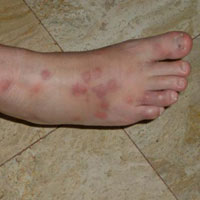 Sức khỏe đời sống - Vì sao muỗi đốt gây sưng và ngứa?