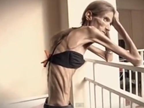 Người phụ nữ gầy nhất thế giới muốn có con - 2