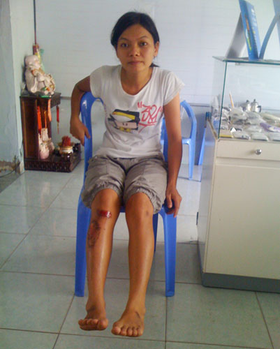 Bắt “cẩu tặc”, một phụ nữ bị kéo lê 30m - 1