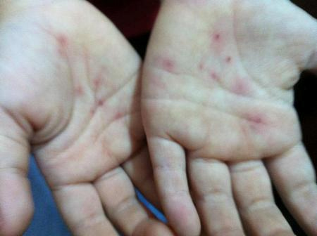 Bé mầm non bị thương: Nghi thủ phạm là củ ấu - 2