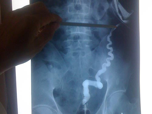 Hạnh phúc sau 40 năm đại tiện bằng hông - 1