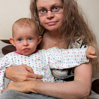 Sức khỏe đời sống - Bệnh lạ: Hai mẹ con bị lột da, bóng nước