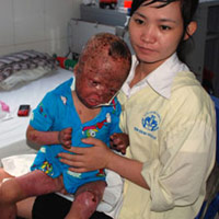 Pháp luật - Bé 3 tuổi bị bố hất xăng đốt giờ ra sao?