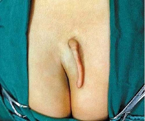 Bé gái chào đời với đuôi dài 6cm - 2