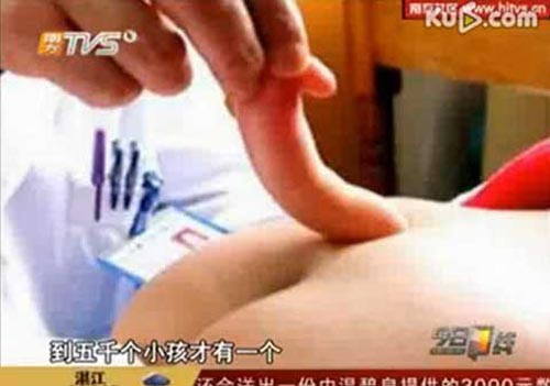 Bé gái chào đời với đuôi dài 6cm - 4