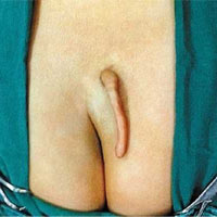 Phi thường - kỳ quặc - Bé gái chào đời với đuôi dài 6cm