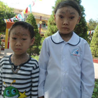 Tin tức trong ngày - Hai chị em ruột mắc bệnh "mắt ma"