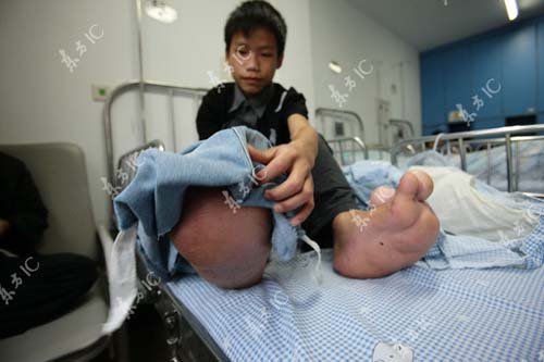 Cậu bé chân to gấp 10 lần bình thường - 3
