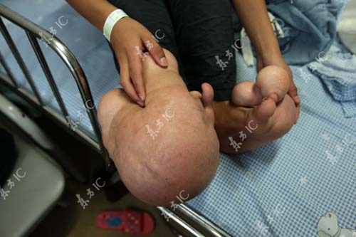 Cậu bé chân to gấp 10 lần bình thường - 4