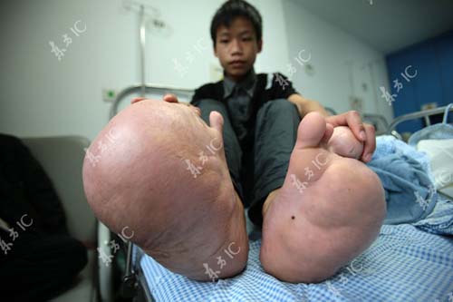 Cậu bé chân to gấp 10 lần bình thường - 2