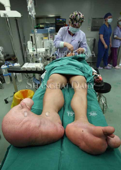 Cậu bé chân to gấp 10 lần bình thường - 5