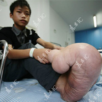 Phi thường - kỳ quặc - Cậu bé chân to gấp 10 lần bình thường