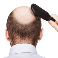 Bí quyết làm đẹp - Đối phó với nỗi lo tóc rụng