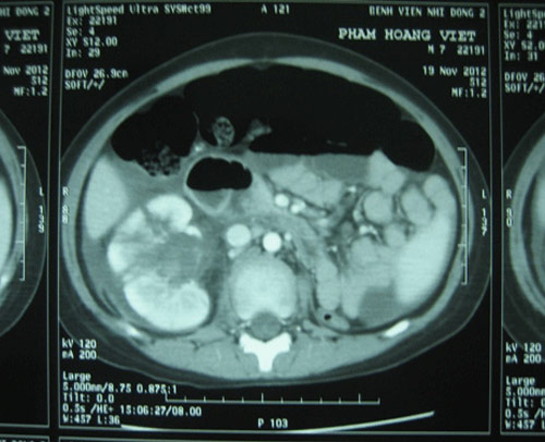 Bị TNGT mới phát hiện bé trai chỉ có 1 quả thận - 2