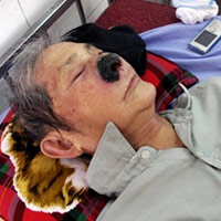 Tin tức trong ngày - Ông già có gần trăm con dòi trong mũi