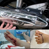 Sức khỏe đời sống - Kinh hoàng nắp pô xe máy "xơi tái" chân người