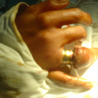 Sức khỏe đời sống - Suýt mất của quý, ngón tay vì đeo nhẫn