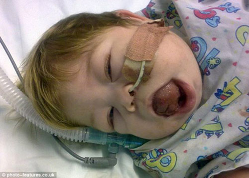 Ngạc nhiên bé gái có lưỡi to gấp 3 lần bình thường - 2