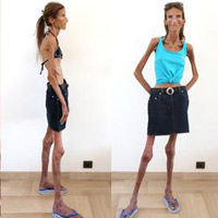 Phi thường - kỳ quặc - Siêu gầy: Cao 1m72 chỉ nặng... 25 kg