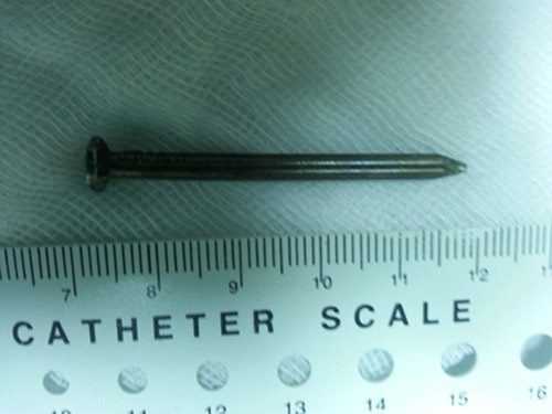 Bé 2 tuổi nuốt gọn đinh sắt dài 5cm vào bụng - 2