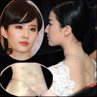 Xu hướng thời trang - Lưu Diệc Phi bị báo chí "soi"... mụn ghẻ