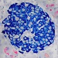 Tìm vắc-xin cho bệnh tiểu đường