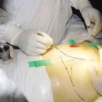 Sức khỏe đời sống - Nâng ngực: Phương pháp hút mỡ đã bị bỏ từ lâu