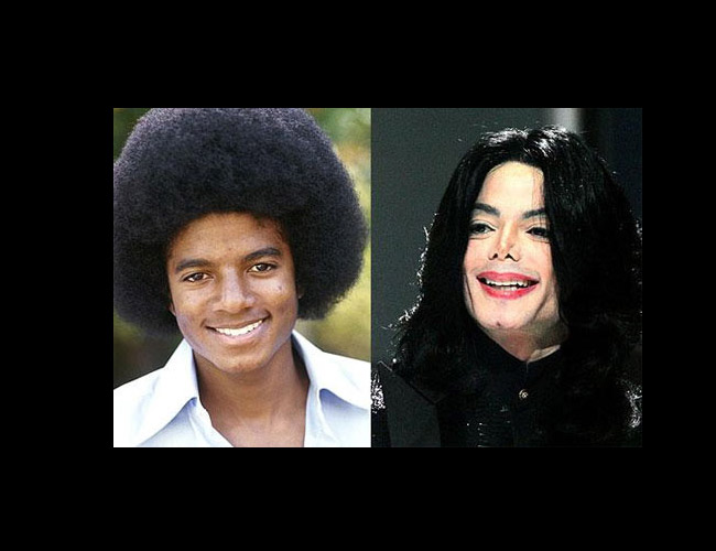 Michael Jackson sở hữu gương mặt dị dạng về cuối đời do hậu quả của chứng nghiện thẩm mỹ.
