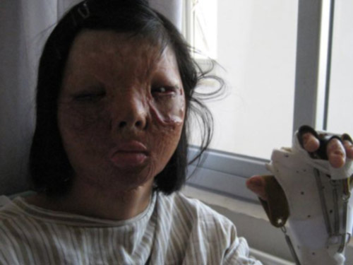 Ghép khuôn mặt được nuôi trên ngực thiếu nữ - 3