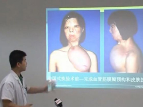 Ghép khuôn mặt được nuôi trên ngực thiếu nữ - 4