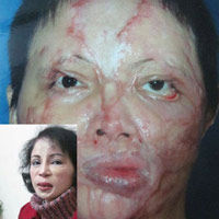 Sức khỏe đời sống - Vụ thẩm mỹ viện Cát Tường: Gặp người 41 lần phẫu thuật