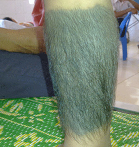 Bé gái bị gọi là người khỉ: VN chỉ có 2 người - 2