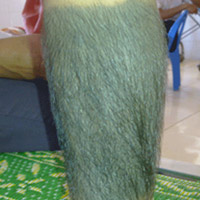 Sức khỏe đời sống - Bé gái bị gọi là người khỉ: VN chỉ có 2 người