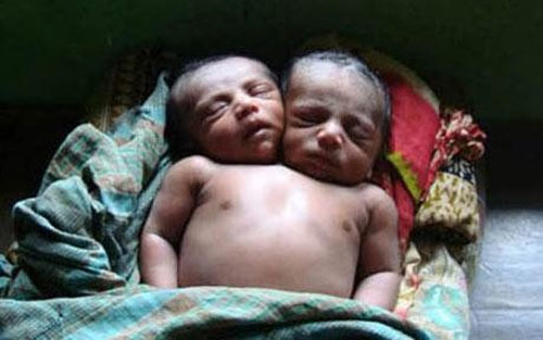 Bé gái hai đầu chào đời tại Ấn Độ - 1