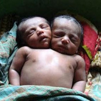 Sức khỏe đời sống - Bé gái hai đầu chào đời tại Ấn Độ
