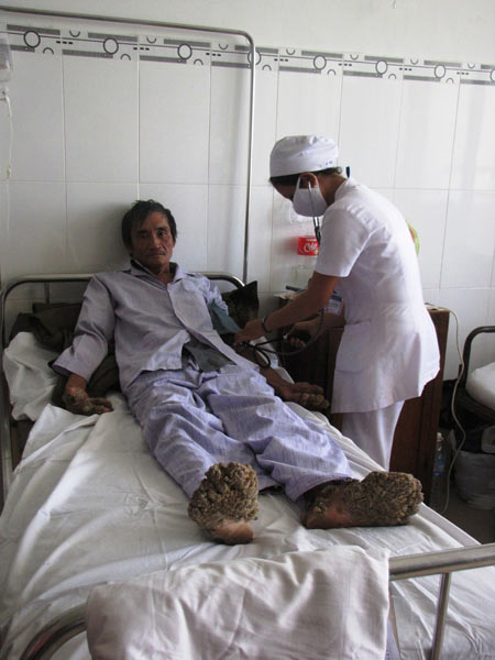 Tay chân người sần sùi như san hô - 2