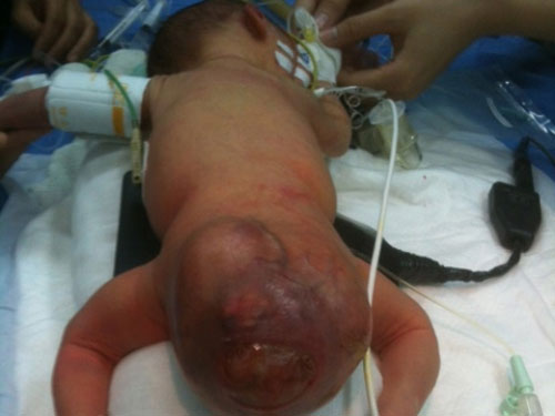 Phẫu thuật thành công khối u hiếm gặp ở trẻ sơ sinh - 1