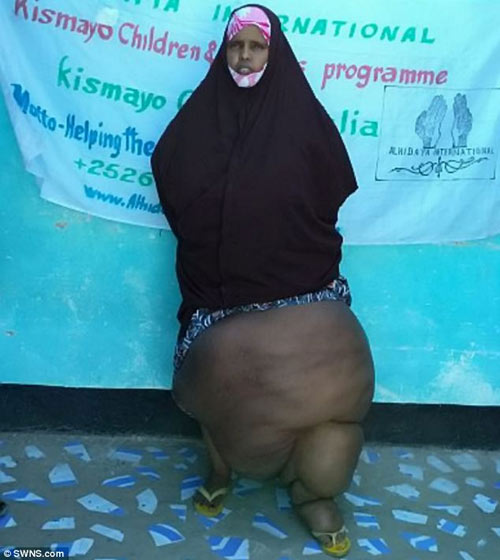Somali: Thảm cảnh của người phụ nữ chân voi - 1