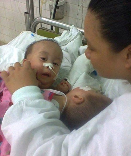 2 bé dính tim: Sinh con 11 tháng, bế con được 1 giờ - 1